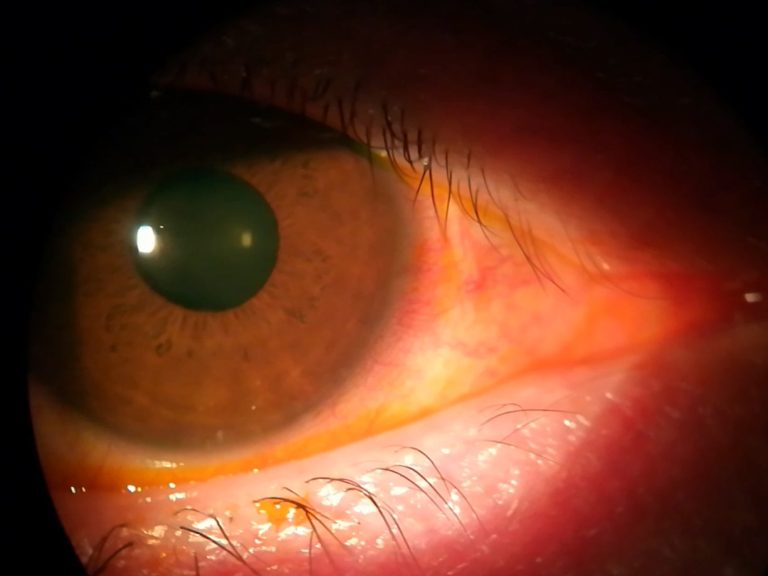 Epiescleritis Primer plano de un ojo con una epiescleritis en el lado nasal del ojo.