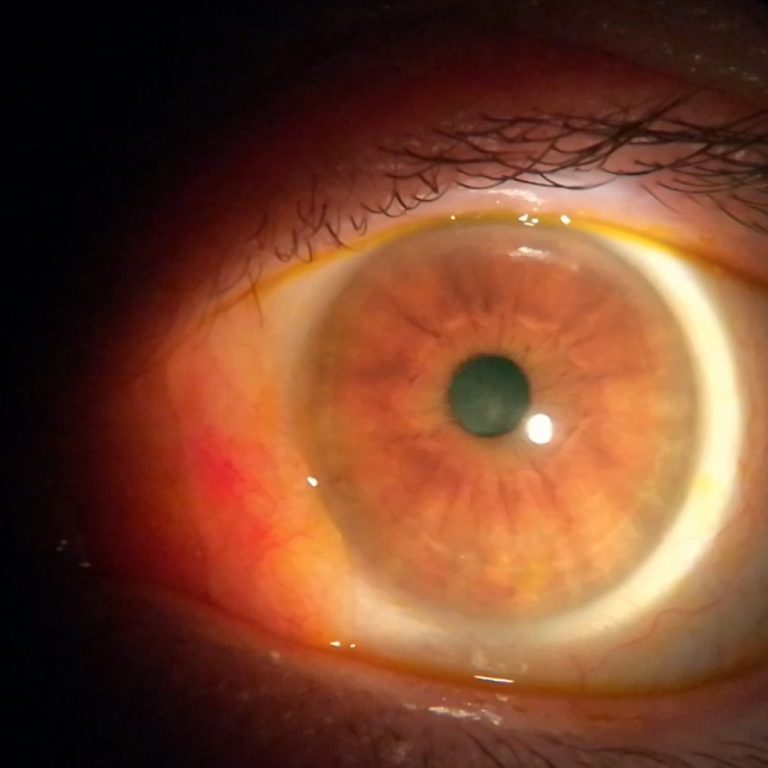 Pingüécula En la imagen se muestra una pingüécula en la parte izquierda, como una protusión de la conjuntiva.