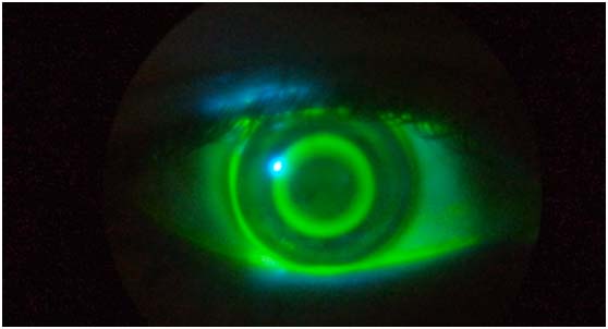 Ojo con una lentilla de orto-k con fluoresceína, con un patrón circular verde en el iris.