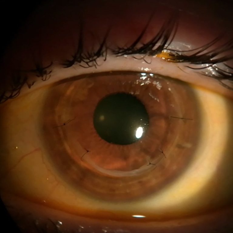 Trasplante de cornea Primer plano de un ojo con trasplante de cornea que aún conserva los puntos de sutura.