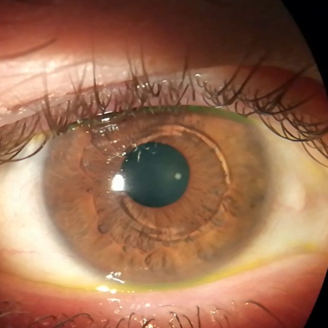 Anillos intraestromales Primer plano de un ojo con dos anillos intraestromales en la cornea.