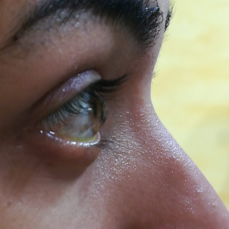 Queratocono en perfil Se muestra el perfil de una cornea con queratocono avanzado, en forma cónica.