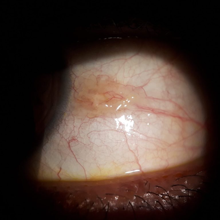 Pingüécula En la imagen se muestra una pingüécula con bastante protusión.