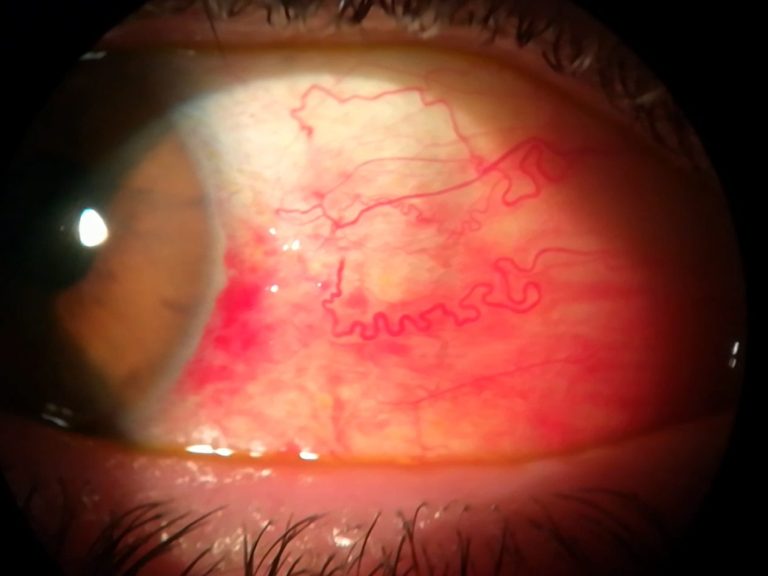 Hiposfagma leve Primer plano de un ojo con un derrame ocular a medio reabsorber.