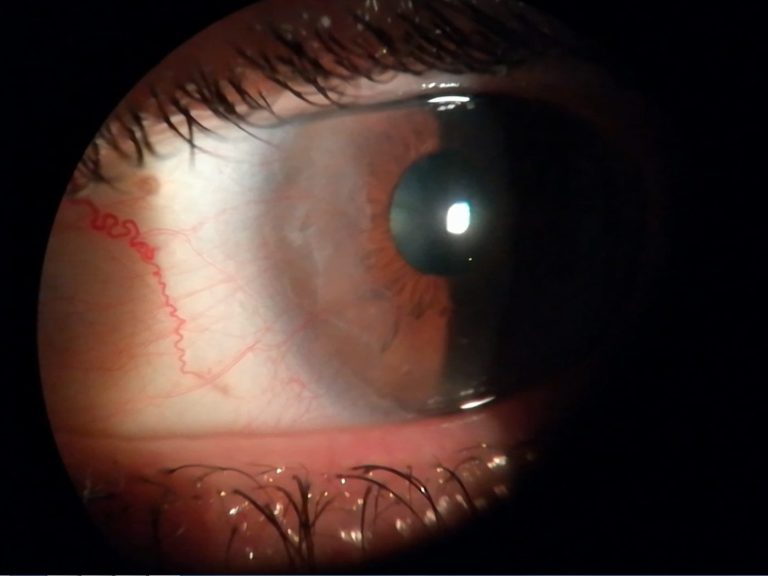 Pterigion Primer plano de un ojo con un pterigion avanzado, llegando casi a la pupila.